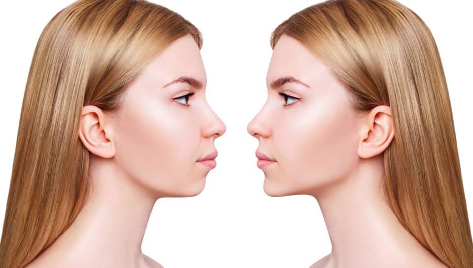 فواید و عوارض زاویه سازی فک چیست؟