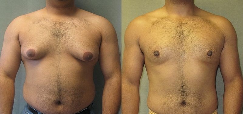 علل، علائم و درمان پف نوک سینه در مردان چیست؟