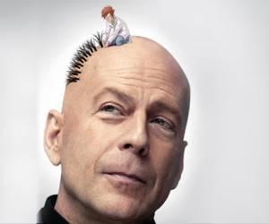 مراحل و سرعت رشد مو بعد از کاشت مو و عوارض رشد مو بعد از کاشت مو