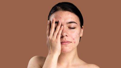 نحوه برنزه کردن پوست های چرب و جوش دار بدون ایجاد حساسیت