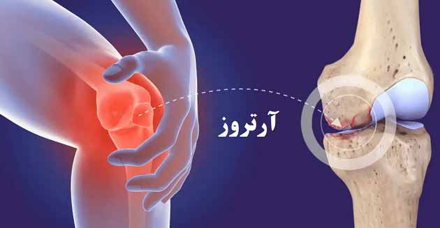 علل، علائم و درمان ریزش مو ناشی از آرتروز