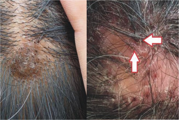 علل، انواع، علائم و درمان سرطان پوست سر چیست؟