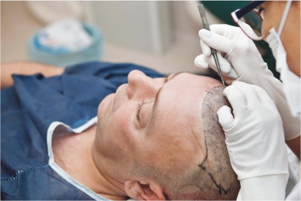 مراحل و سرعت رشد مو بعد از کاشت مو و عوارض رشد مو بعد از کاشت مو